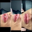 Profesjonalny zabieg powiększania ust kwasem hialuronowym